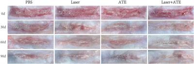A novel combined technology for treating hypertrophic scars: adipose tissue extract combined with fractional CO2 laser